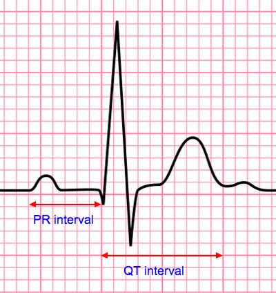 The Basics of ECG Interpretation (Part 3 – Waves, Segments & Intervals)