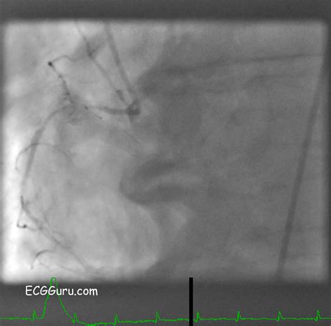 Right coronary artery | ECG Guru - Instructor Resources
