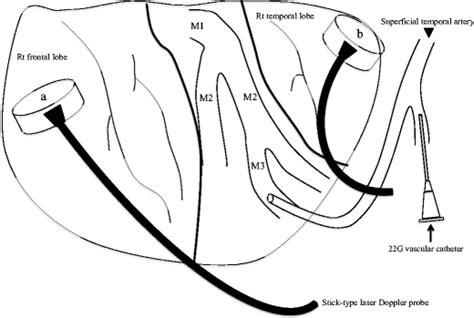 Intraoperative Cortical Blood Flow And Middle Cerebral Artery Pressure