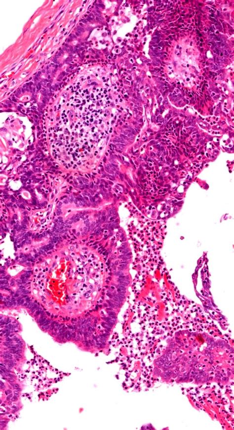 Pathology Of Syringocystadenoma Papilliferum