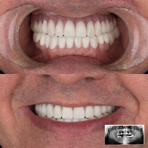 Dental Implant Teeth Implants Turkey Dental Implant Istanbul