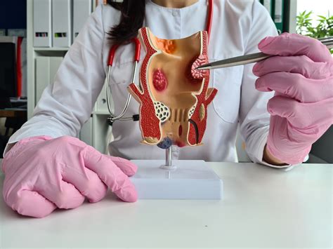 Hemorrhoid Anal Fissure Differences N A Hemorrhoids Clinic