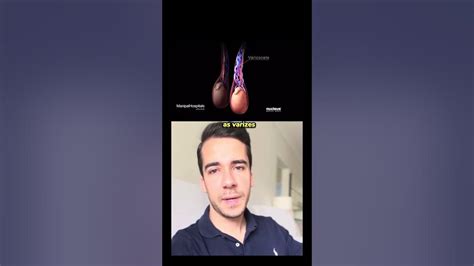 Entenda Como é Feita A Cirurgia De Varicocele Youtube