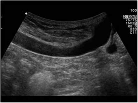 Paraumbilical Vein Ultrasound