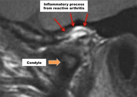 Mri Evaluation For Tmj Dr Larry M Wolford Dmd