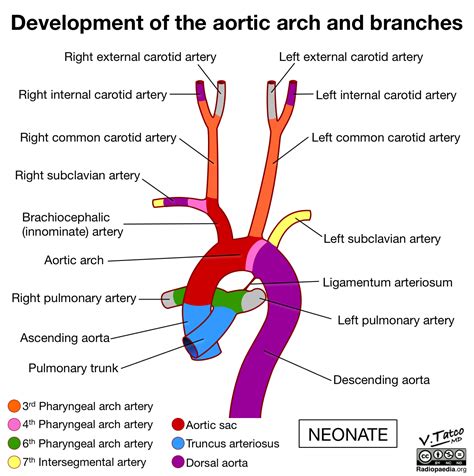 Radiopaedia Drawing Aortic Arch And Branches Of A Neonate English