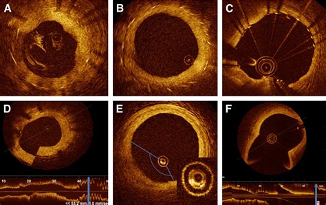 Intracoronary Optical Coherence Tomography A Comprehensive Review