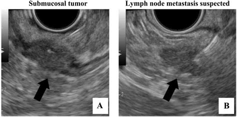 Local Recurrence Of T A Rectal Cancer Following Radical Endoscopic