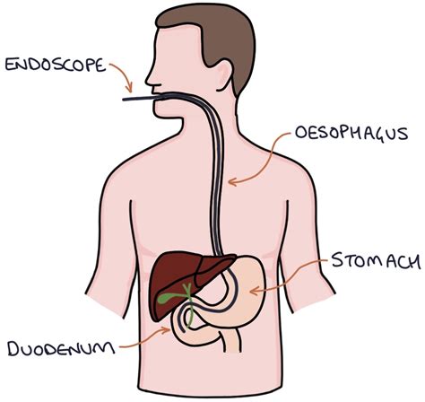 Primary Sclerosing Cholangitis Zero To Finals