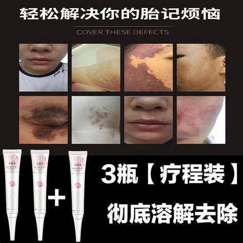 Quick Birthmark Removal Birthmark Removal Artifact Removing Melanin