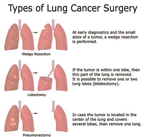 Surgical Options for Lung Cancer | Stony Brook Cancer Center