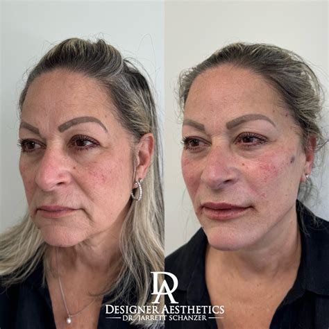 PDO Thread Lift - Designer Aesthetics by Dr. Jarrett Schanzer | Miami