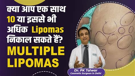 How Many Lipomas Can Be Removed At Once Multiple Lipoma Removal