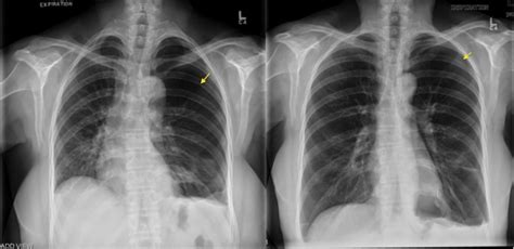 Pneumothorax Expiration Radiology At St Vincents University Hospital