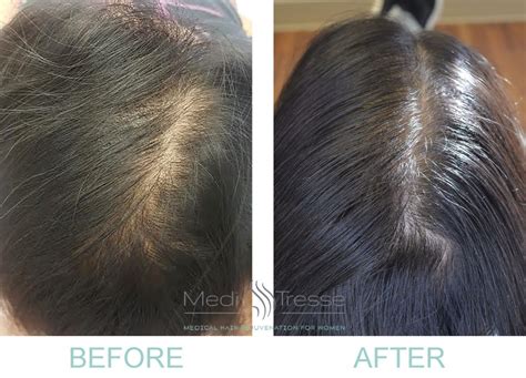 PRP Before and After Photos | Medi Tresse Boston