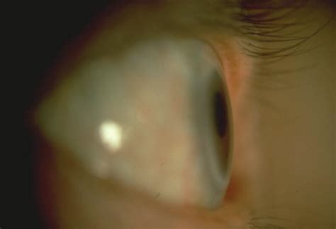 Mt Corneal Dysgeneses Dystrophies Other Corneal Conditions