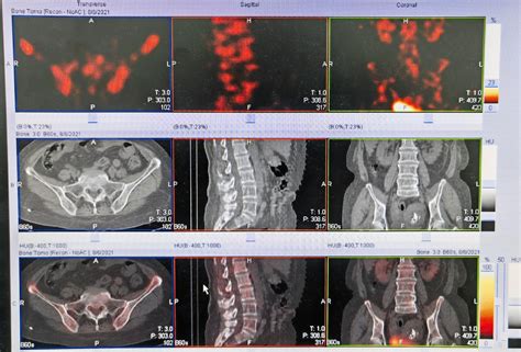 Bone Scan Imaging Shows Uneven Bone Density In The Lumbar Spine And