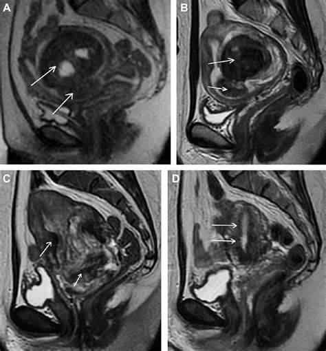 Spontaneous Vaginal Expulsion Of Uterine Myoma After Magnetic Resonance