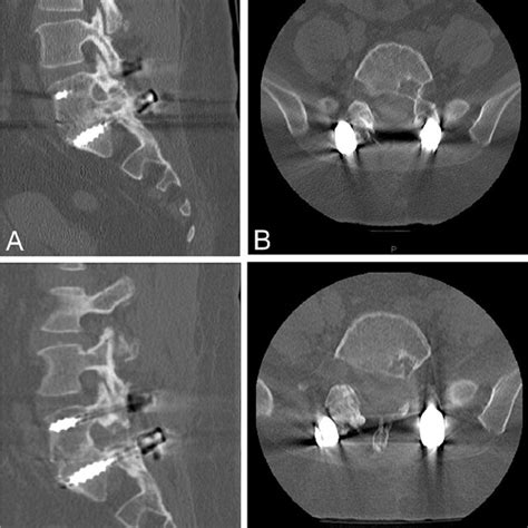 Pre And Postoperative Sagittal And Axial Ct Images Preoperative Download Scientific Diagram