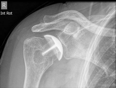 Shoulder Resurfacing Arthroplasty Radiology Reference Article