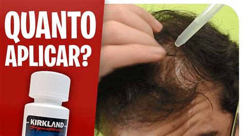 Minoxidil No Cabelo Como Utiliz Lo Da Forma Correta