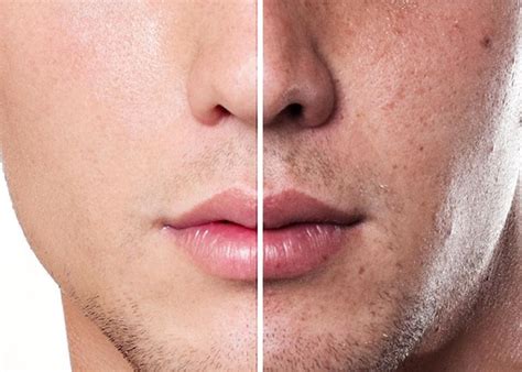 Melasma In Men Vinmec