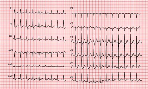 Av Nodal Reentrant Tachycardia