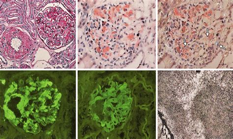 A To F A Renal Biopsy Showing Light Microscopy Findings In Al Download Scientific Diagram