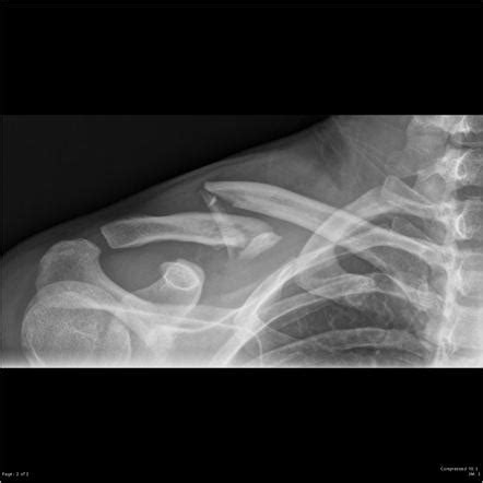 Clavicle Ap Cephalic View Radiology Reference Article Radiopaedia Org