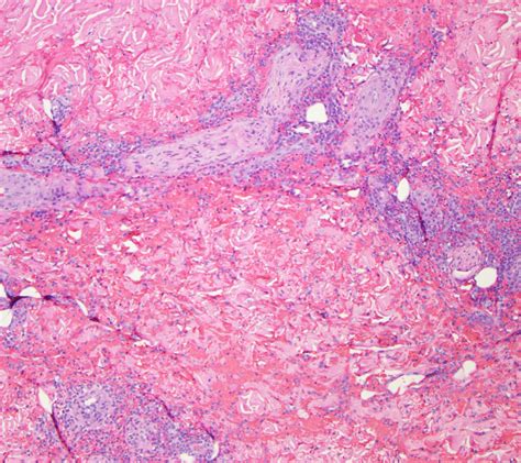 Acute Myeloid Leukemia Cutis Dermatopathology