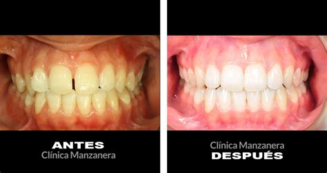 Ortodoncia Antes Y Despues