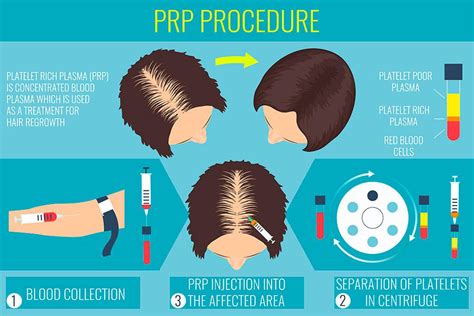 Prp Plazma Treatment Sem