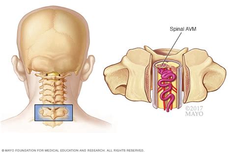 Spinal arteriovenous malformation (AVM) - Symptoms and causes - Mayo Clinic
