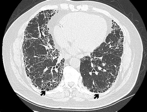 Pulmonary Fibrosis / ILD: Diagnosis, Treatment, and Support for Better