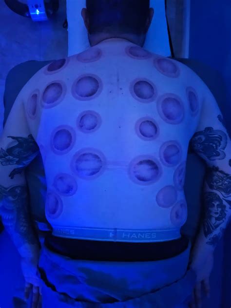 Cupping therapy | ChillNOut Reseda