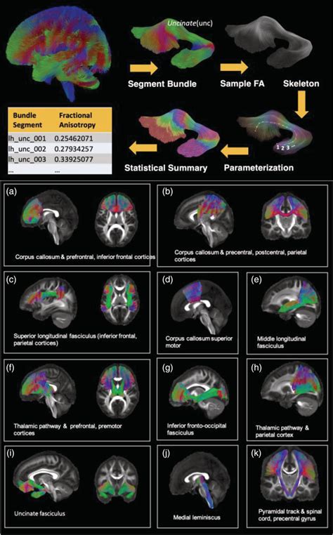 Processing Protocol Of Dti Tractography A And White Matter Tract