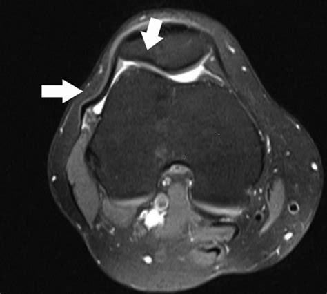 MRI Findings Of Iliotibial Band Friction Syndrome On Axial Proton