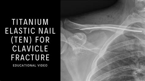 titanium plate clavicle fracture  clyde rucker blog