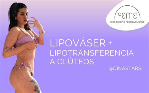 DINA STARS lipováser con lipotransferencia a glúteos