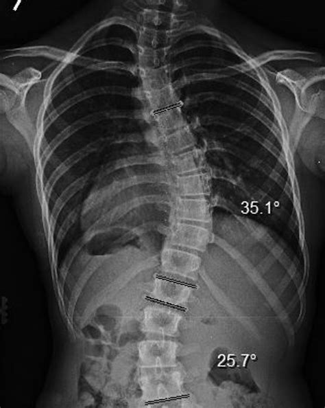Spinal Technology | Types of Scoliosis