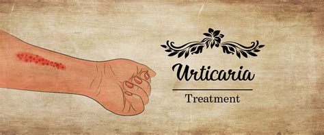 Ayurvedic Urticaria Treatment In Pune Dr Manoj M Deshpande