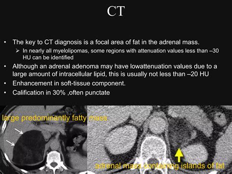 Imaging Of Adrenal Masses Abdulj Final Ppt