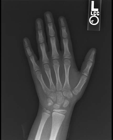 bone age wikidoc