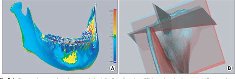 Figure From Unilateral Intraoral Vertical Ramus Osteotomy Based On