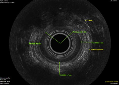 Obstetric Anal Sphincter Injuries Oasis Halo Medical Technologies