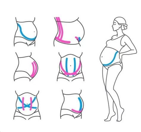 Тейпирование для похудения схемы наложения 51 фото - wForm.ru