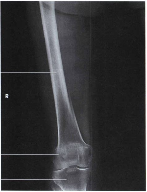 gudang medis teknik radiografi femur