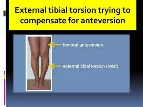 External Tibial Torsion