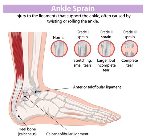 Ankle Sprain Symptoms Causes Treatment Ankle Sprain