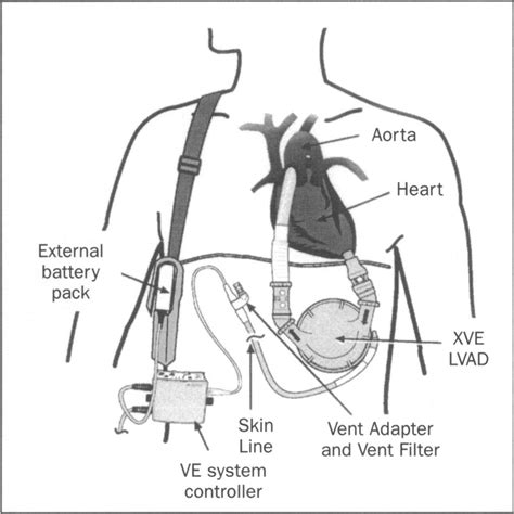 Schematic Drawing Of A Left Ventricular Assist Device Download